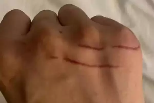 被猫抓伤出血需不需要打针呢,被猫抓伤出血要打针吗插图2