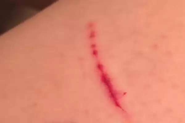 被猫抓伤出血需不需要打针呢,被猫抓伤出血要打针吗插图1