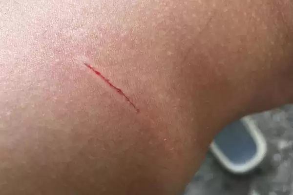 判断羊牙齿划破手指是否要打疫苗的方法和重点?判断羊牙齿划破手指是否要打疫苗要做好哪些细节?插图3 判断羊牙齿划破手指是否要打疫苗的方法和重点?判断羊牙齿划破手指是否要打疫苗要做好哪些细节?插图3