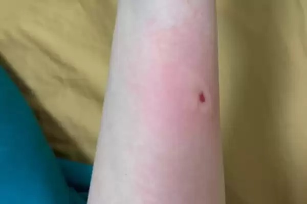 马蜂蛰了如何消肿，及时将毒针用镊子拔出来插图1