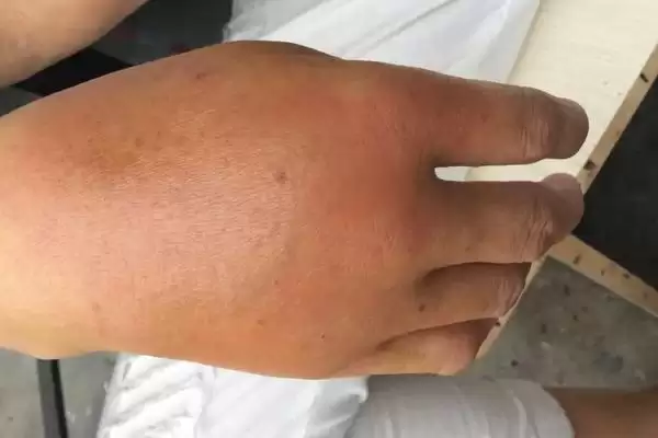被马蜂蛰了怎么办，蜂毒过敏比蜂毒本身要危险插图1