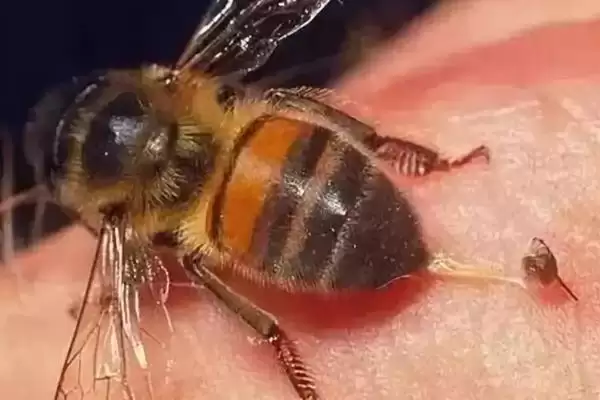 被马蜂蛰了怎么办，蜂毒过敏比蜂毒本身要危险插图2