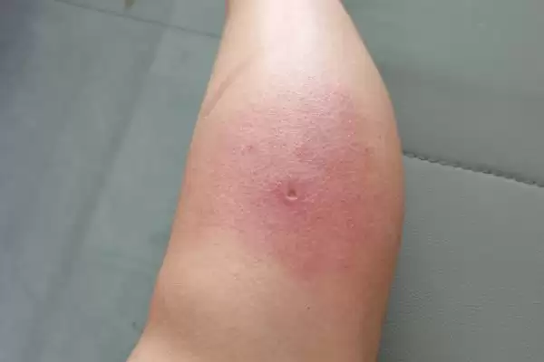 马蜂蛰了如何消肿，及时将毒针用镊子拔出来插图2